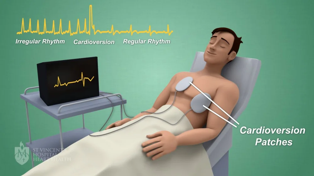 Cardioversion 100j Cardioversión: Procedimiento, Tratamiento y Recuperación | Guía de ...