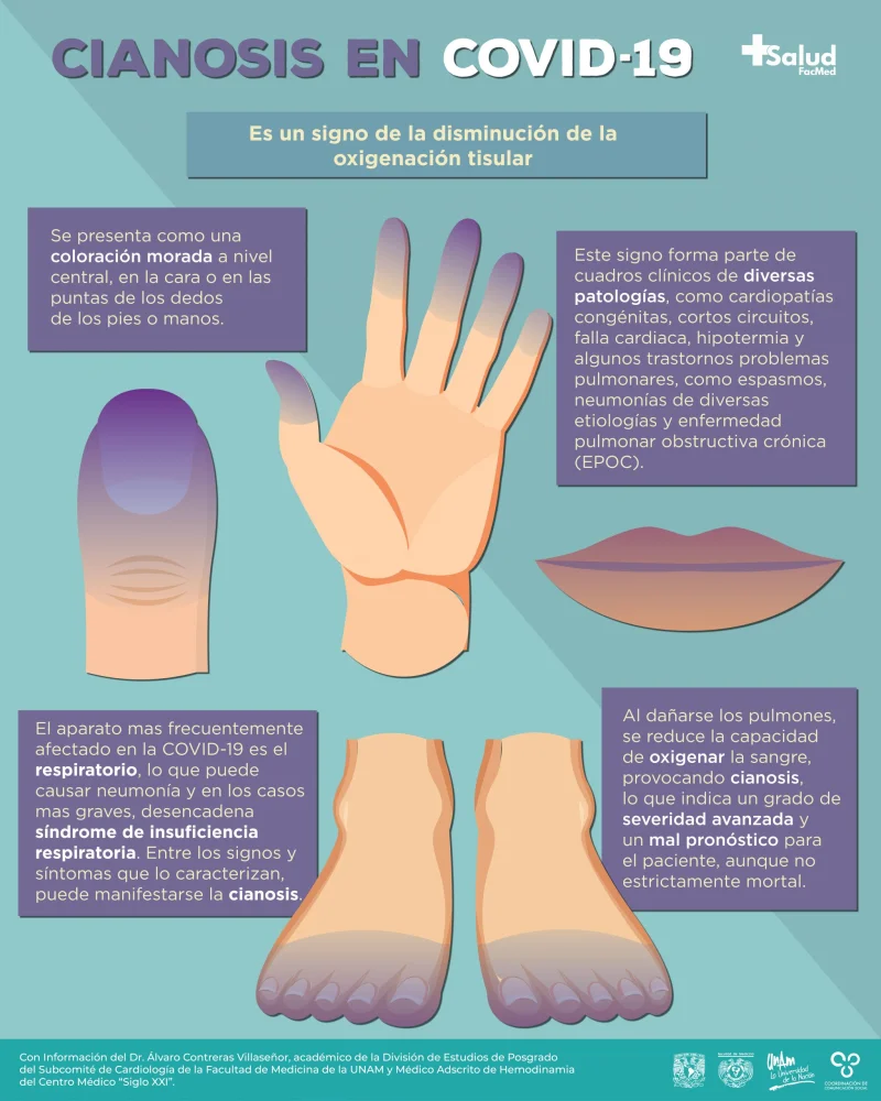 Cianosis (manos y pies azulados): causas, tratamiento y diagnóstico ...