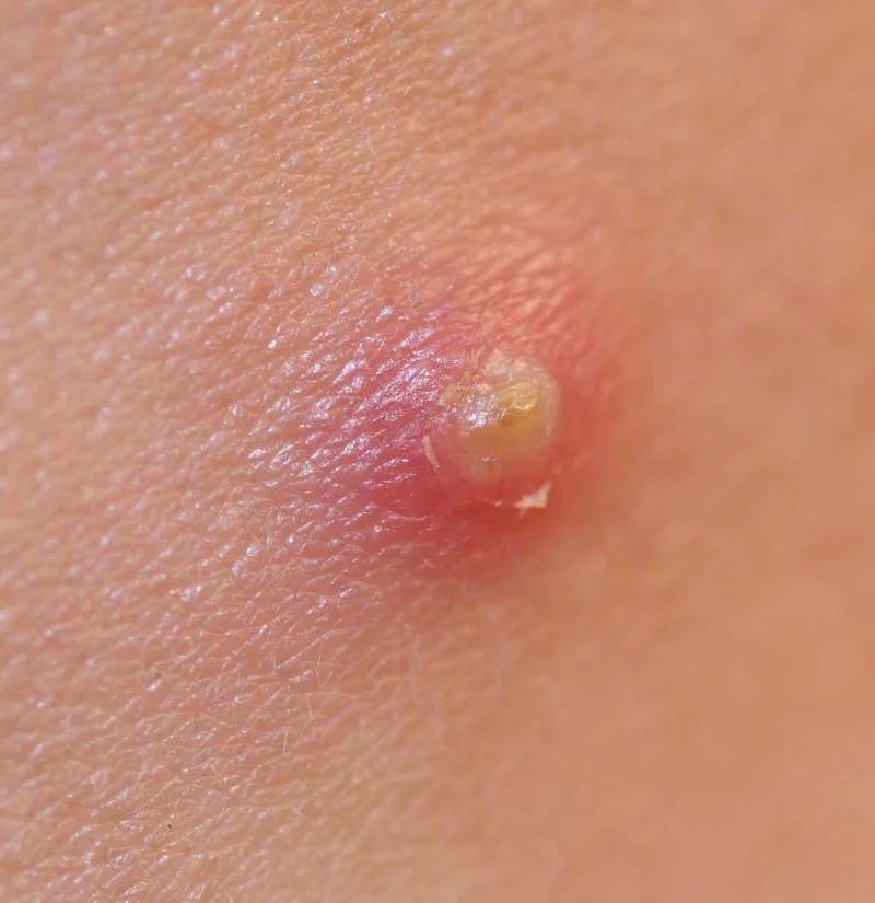 Pena Infectado Grano infectado: cómo se ve, causas y tratamiento | Guía de salud ...