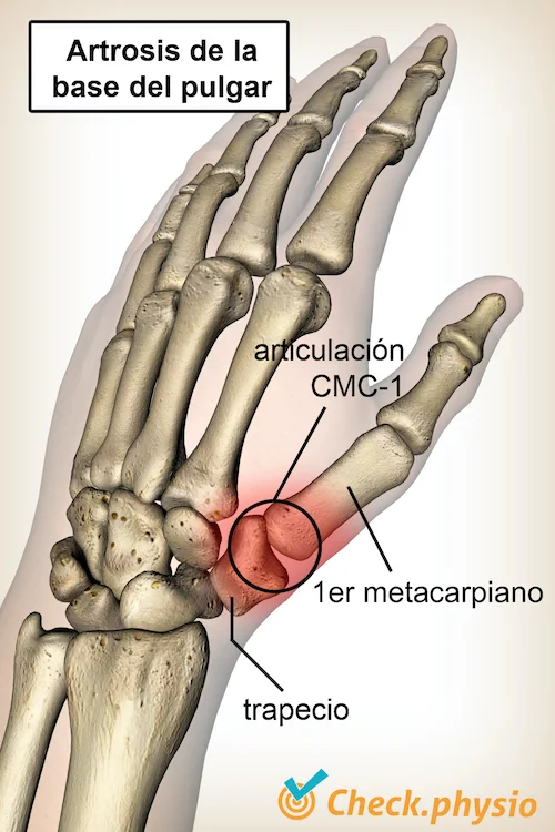 ¿Qué es la artritis del pulgar? | Guía de salud | Vidaliax