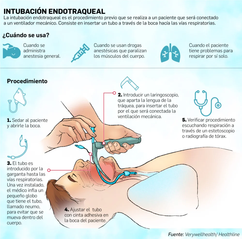 ¿Qué es la intubación? | Guía de salud | Vidaliax
