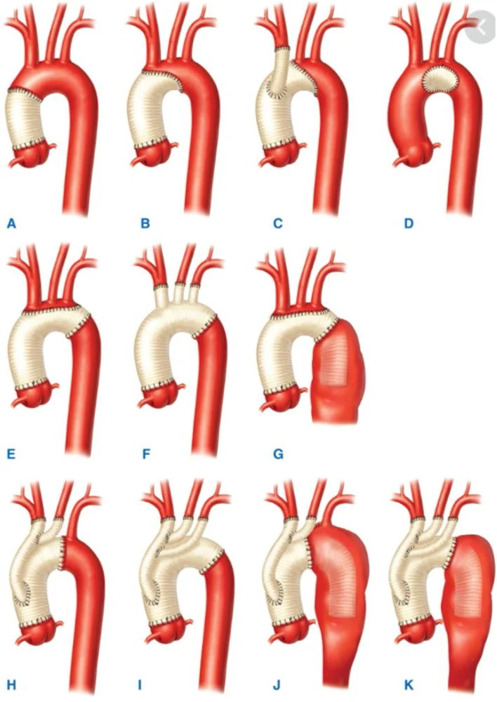 Reparación del aneurisma de la aorta ascendente | Guía de salud | Vidaliax