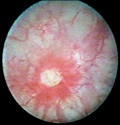 Hunner Files ¿Qué son las úlceras de Hunner? | Guía de salud | Vidaliax